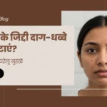 पिंपल के जिद्दी दाग-धब्बे